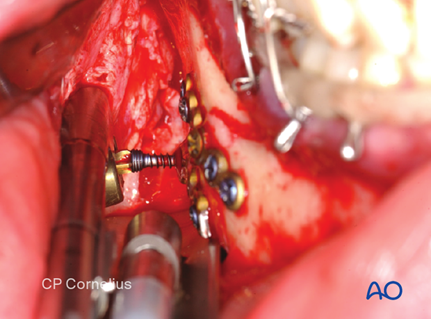 Screw insertion using an angulated screwdriver