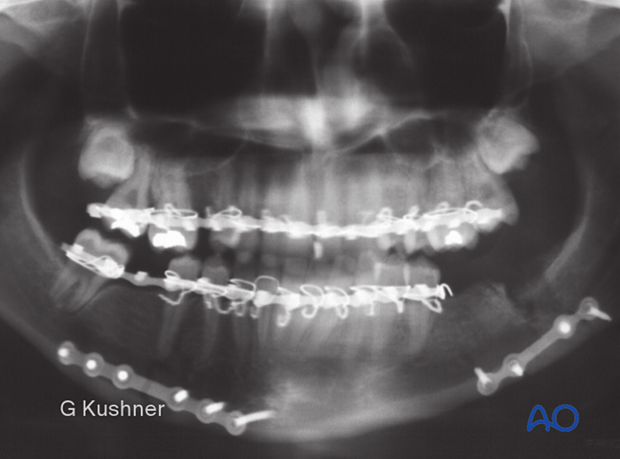 Left mandibular angle fracture was treated using a malleable 2.0 miniplate at the inferior border of the mandible. This fixation is insufficient for this fracture