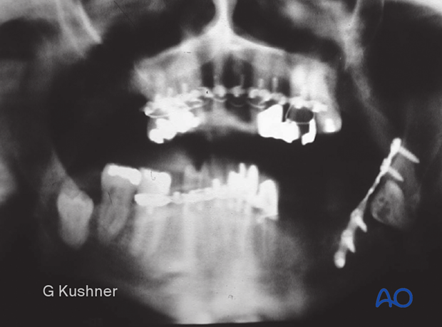 X-ray shows a superior border miniplate.