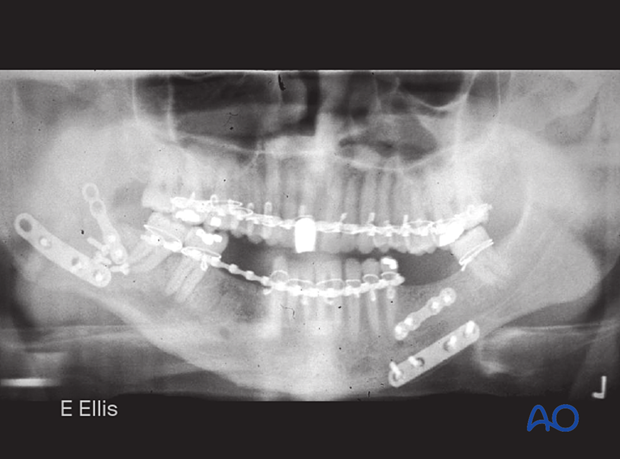 Devitalization of bone around screws