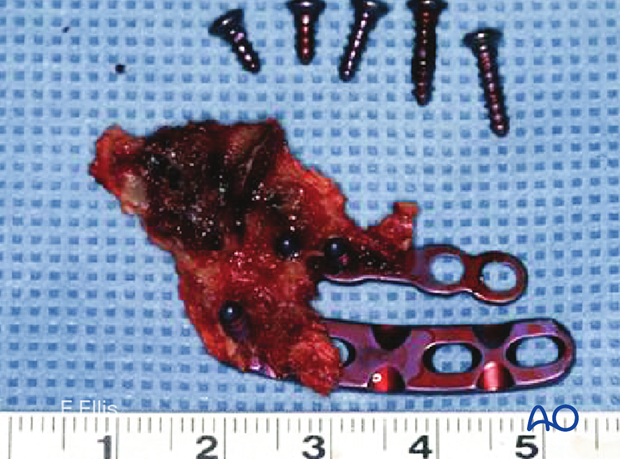 The fracture was opened, and hardware was still attached to portions of the buccal cortex, which was devitalized and had sequestered