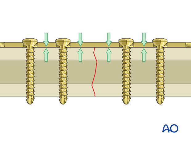 Non locking screws pulling the plate to the bone