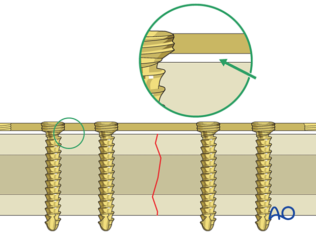 Locking head screws are engaged in the plate, and the plate is not pressed against the bone. 