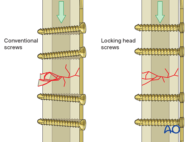 The locking plate and screws provide adequate rigidity and do not depend on the underlying bone buttressing 