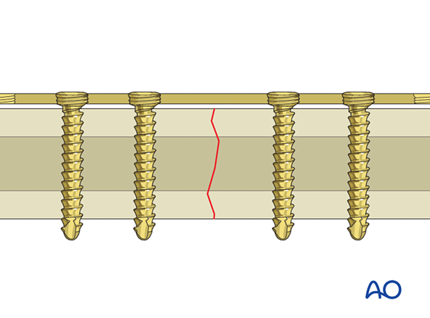 Locking head screws inserted in to the bone and plate