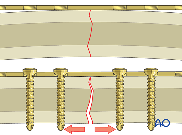 Precise plate adaptation is necessary when nonlocking screws are used