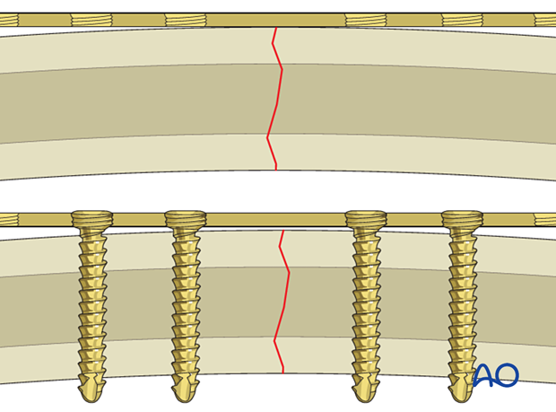 Precise plate adaptation is no needed when locking head screws are used. 