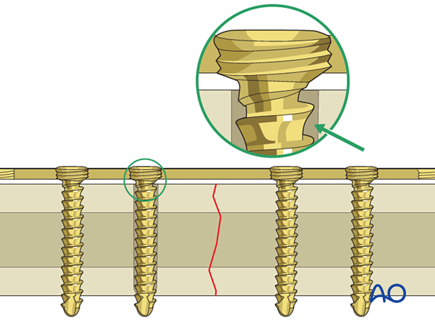 Overdrilled scew hole