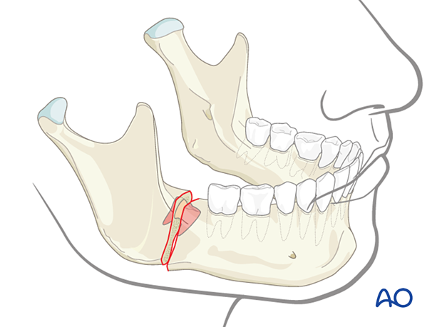 Displaced fracture with tooth in the line of fracture