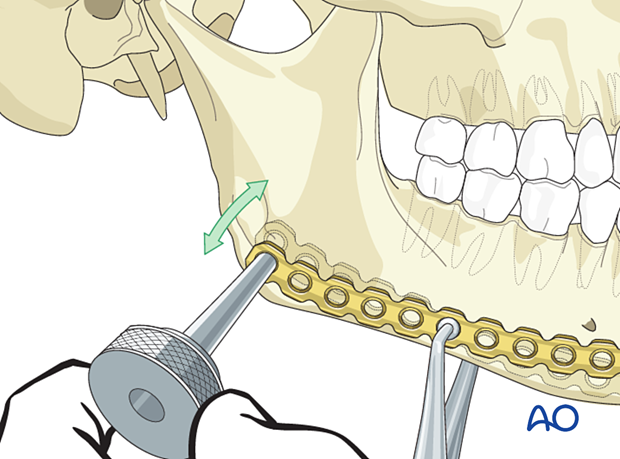 Drilling of the hole