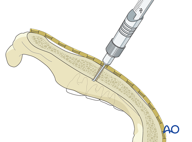 Screw length determination