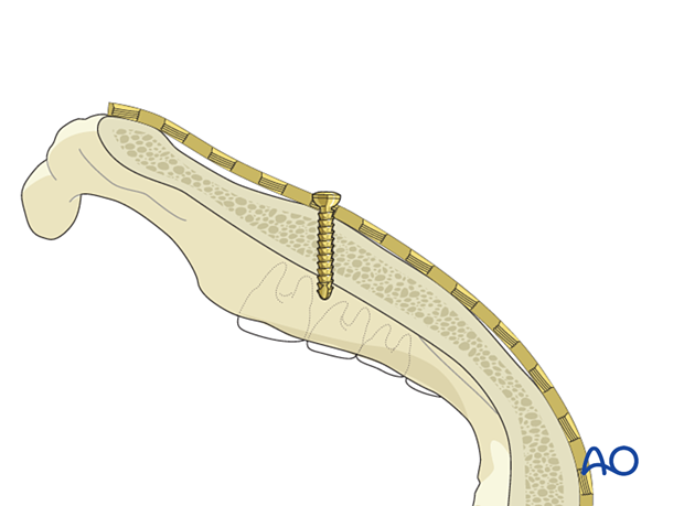 91 X060 Screw insertion into locking plates   