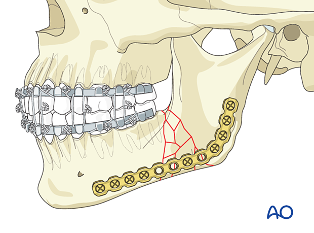 Load bearing requires large and rigid plates as they bear all the forces of function at the fracture site and provide absolute stability. 