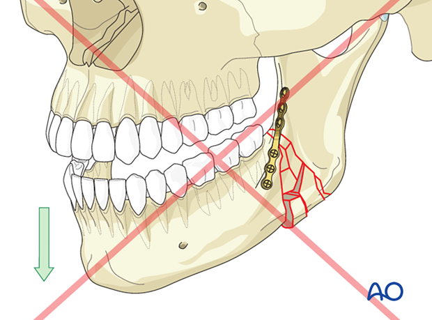 Load-sharing osteosynthesis cannot be used with defect fractures or comminuted fractures due to the fracture site's lack of bony buttressing