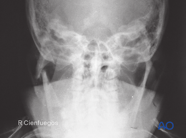 With a condylar fracture, there is often shortening of the ramus on the affected side