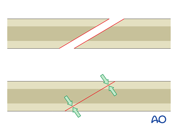 Simple oblique fracture