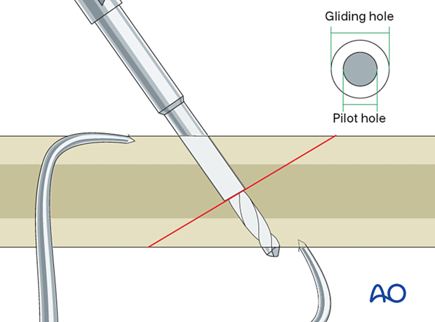 Drill the pilot hole. The drill bit should penetrate the far cortex.