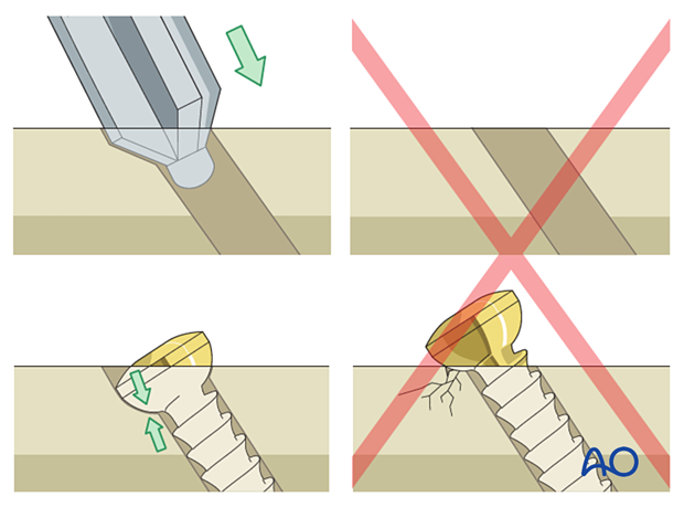 Countersinking