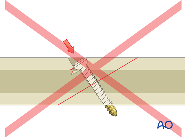 When the cortex is thin, it is imperative that countersinking does not remove all the cortical bone around the circumference of the head of the screw