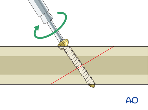 Screw insertion