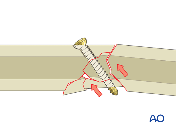 91 X080 Lag screw technique