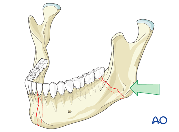 A blow to the mandibular angle will likely cause a fracture of that angle and potentially a contralateral fracture of the body or symphysis. 