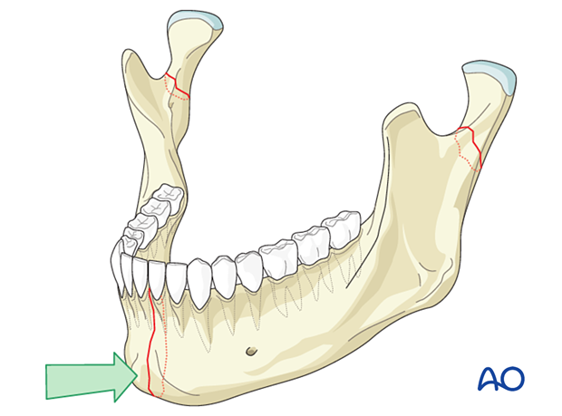 Impact on the chin would lead one to suspect a symphysis or condylar fracture, or both. 