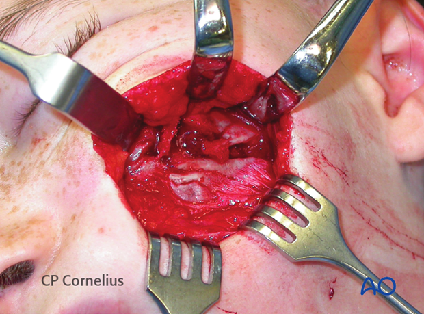 Underlying multifragmentary zygoma fracture