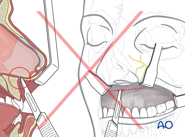 Maxillary vestibular approach