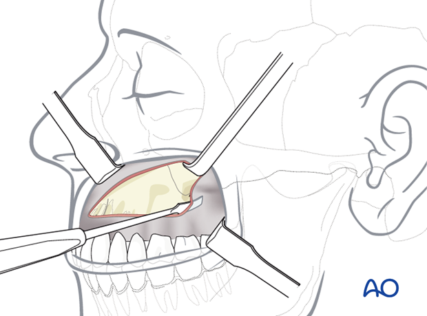 Maxillary vestibular approach