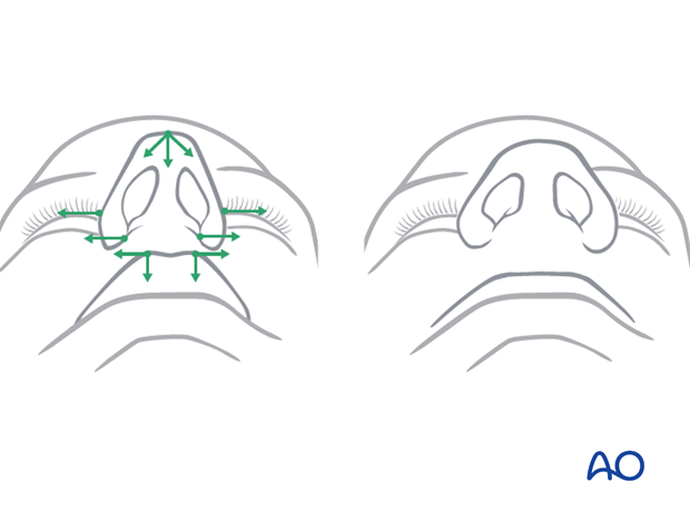 Maxillary vestibular approach