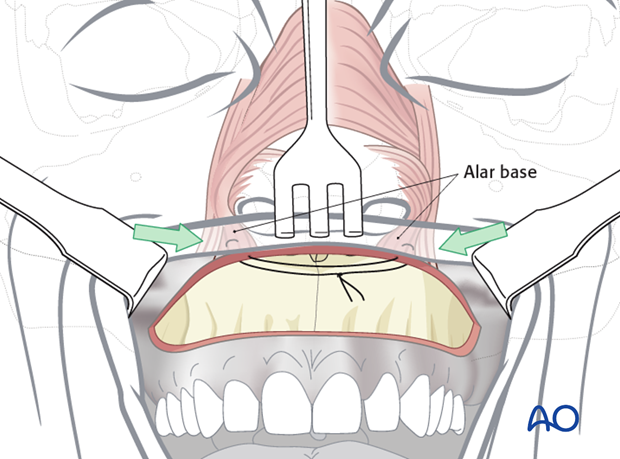 Maxillary vestibular approach