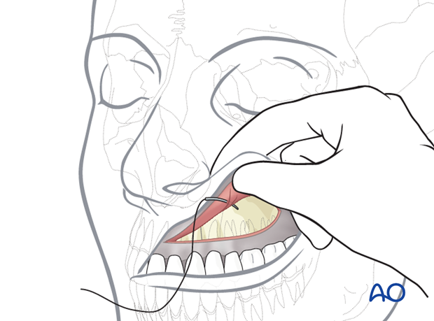 Maxillary vestibular approach