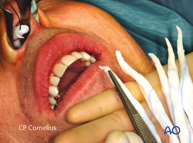 Maxillary vestibular approach