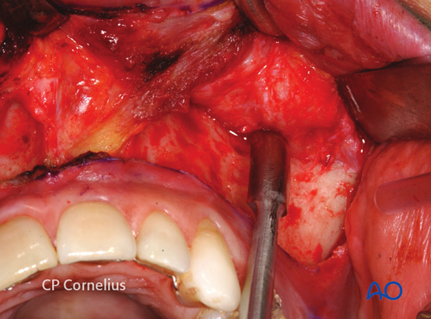 Maxillary vestibular approach