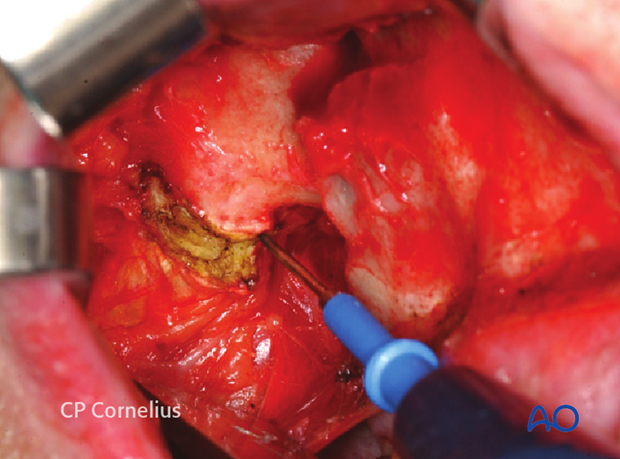 Maxillary vestibular approach