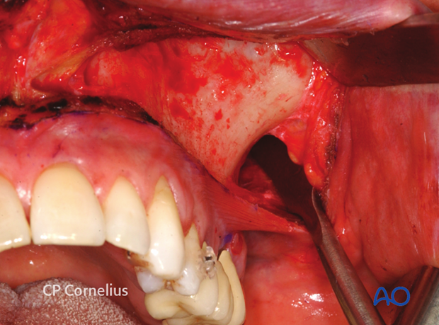 Maxillary vestibular approach