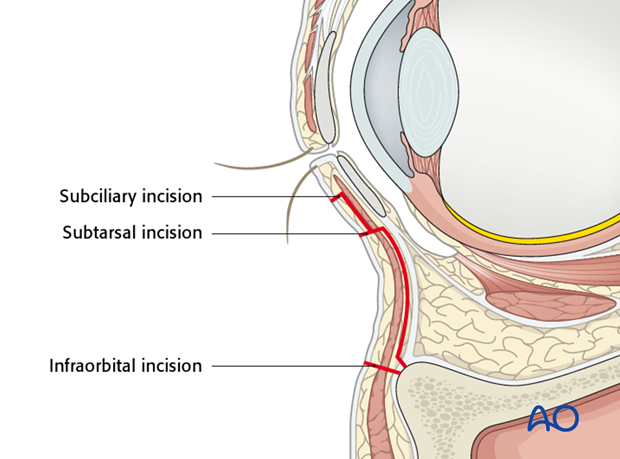 Transcutaneous lower-eyelid approach