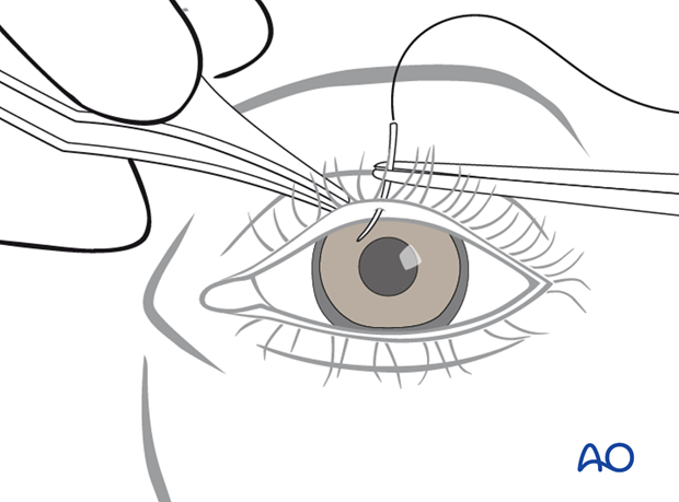 Transcutaneous lower-eyelid approach