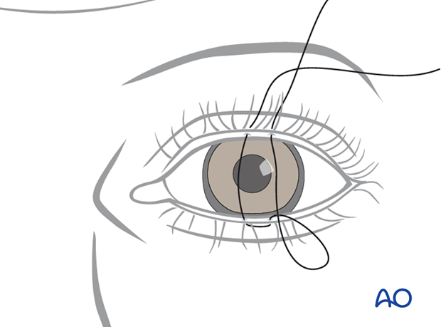 Transcutaneous lower-eyelid approach