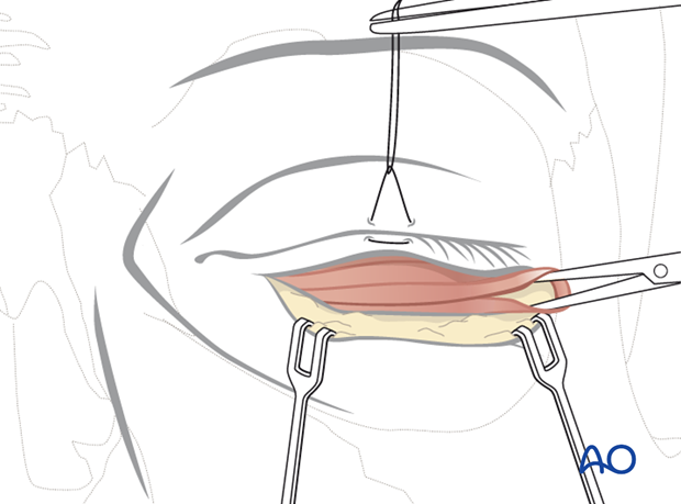 subciliary approach