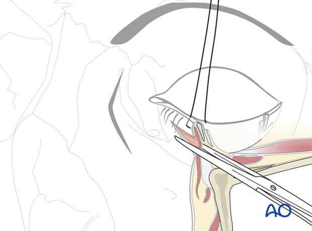 subciliary approach