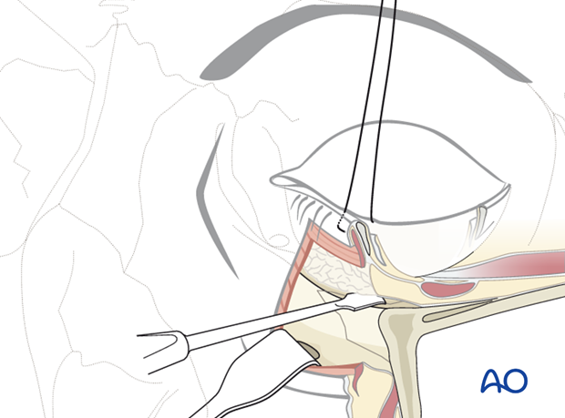 subciliary approach