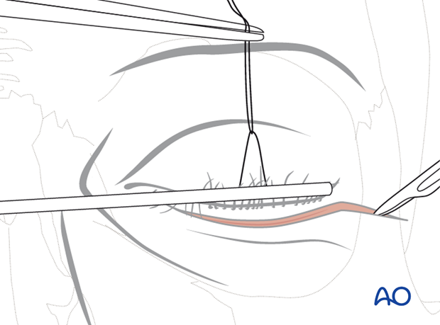 subciliary approach