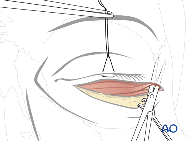 subciliary approach