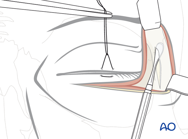 subciliary approach