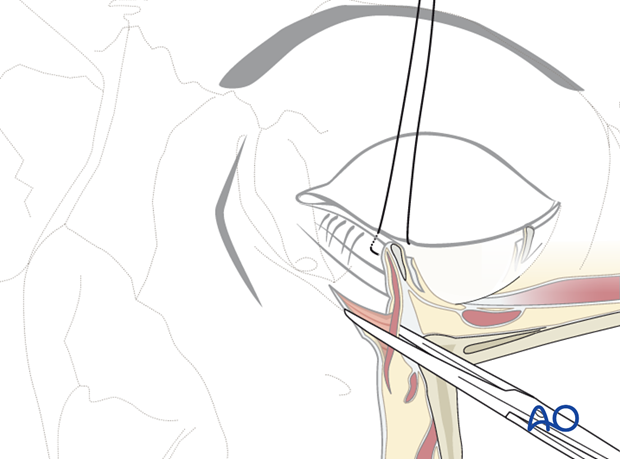 Subtarsal approach