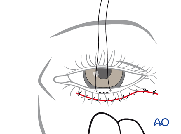 Subtarsal approach