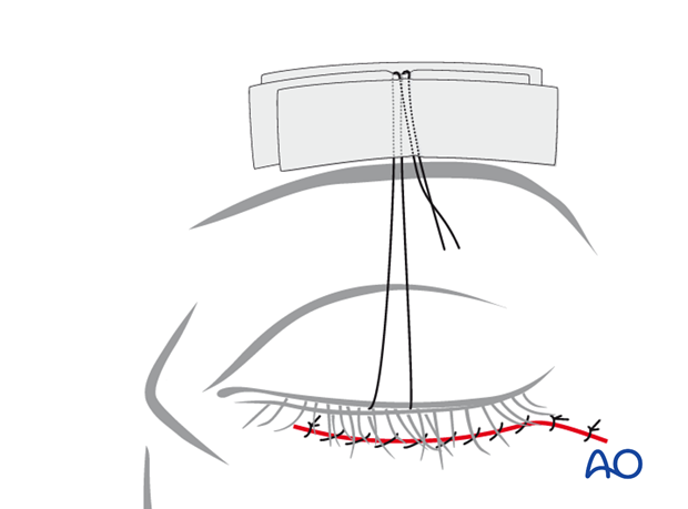 subciliary approach