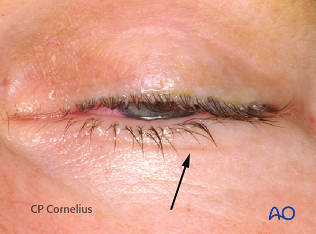 Subtarsal approach